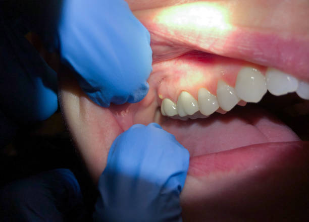 Best Emergency Root Canal Treatment in Hampton, TN